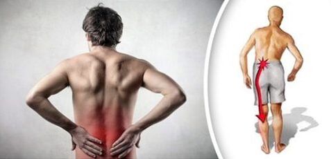 متلازمة الألم مع هشاشة العظم القطني يشع على الساقين
